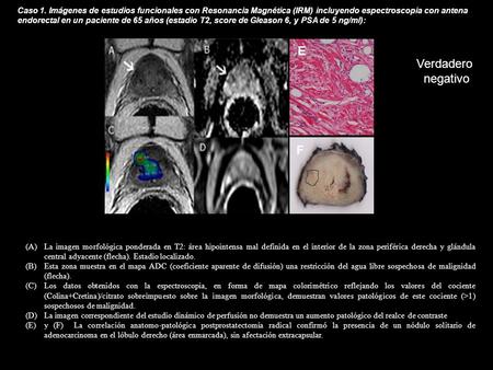 Caso 1. Imágenes de estudios funcionales con Resonancia Magnética (IRM) incluyendo espectroscopia con antena endorectal en un paciente de 65 años (estadio.