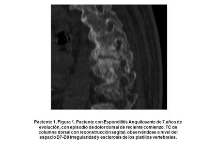 Paciente 1. Figura 1. Paciente con Espondilitis Anquilosante de 7 años de evolución, con episodio de dolor dorsal de reciente comienzo. TC de columna dorsal.