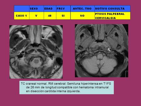 TC craneal normal. RM cerebral: Semiluna hiperintensa en T1FS de 26 mm de longitud compatible con hematoma intramural en disección carótida interna izquierda.