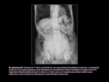 Rx abdomen AP. Paciente de 71 años con Alzheimer, con masa abdominal palpable no dolorosa. La radiografía evidenció una imagen hiperdensa, bien delimitada,