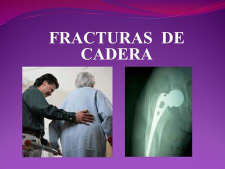 FRACTURAS DE CADERA.