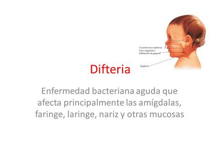 Difteria Enfermedad bacteriana aguda que afecta principalmente las amígdalas, faringe, laringe, nariz y otras mucosas.