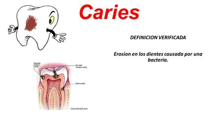 Caries DEFINICION VERIFICADA Erosion en los dientes causada por una bacteria.