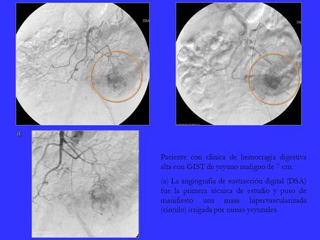 A Paciente con clínica de hemorragia digestiva alta con GIST de yeyuno maligno de 7 cm. (a) La angiografía de sustracción digital (DSA) fue la primera.