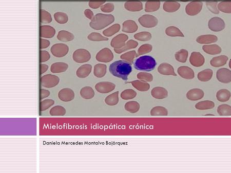 Mielofibrosis idiopática crónica
