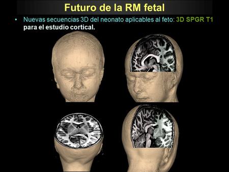 Futuro de la RM fetal Nuevas secuencias 3D del neonato aplicables al feto: 3D SPGR T1 para el estudio cortical.