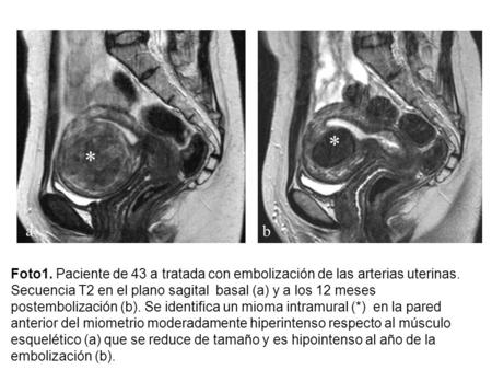 Foto1. Paciente de 43 a tratada con embolización de las arterias uterinas. Secuencia T2 en el plano sagital basal (a) y a los 12 meses postembolización.