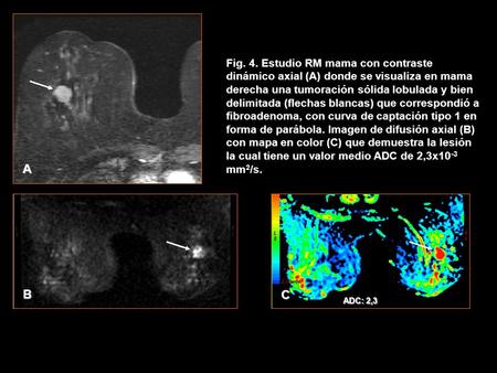 Fig. 4. Estudio RM mama con contraste dinámico axial (A) donde se visualiza en mama derecha una tumoración sólida lobulada y bien delimitada (flechas blancas)