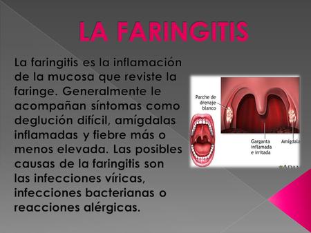 LA FARINGITIS La faringitis es la inflamación de la mucosa que reviste la faringe. Generalmente le acompañan síntomas como deglución difícil, amígdalas.