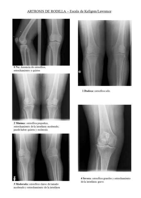 ARTROSIS DE RODILLA – Escala de Kellgren/Lawrence