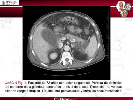 [1 ] CASO 4 Fig. 1. Paciente de 72 años con dolor epigástrico. Pérdida de definición del contorno de la glándula pancreática a nivel de la cola. Distensión.