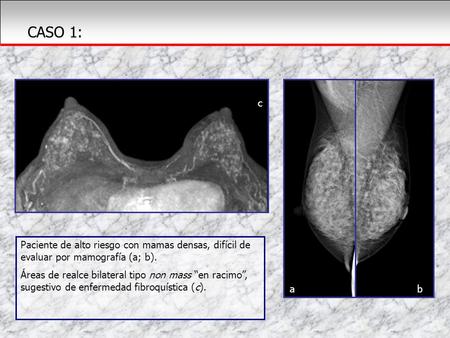 CASO 1: c Paciente de alto riesgo con mamas densas, difícil de evaluar por mamografía (a; b). Áreas de realce bilateral tipo non mass “en racimo”, sugestivo.