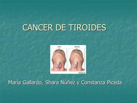 CANCER DE TIROIDES María Gallardo, Shara Núñez y Constanza Piceda.