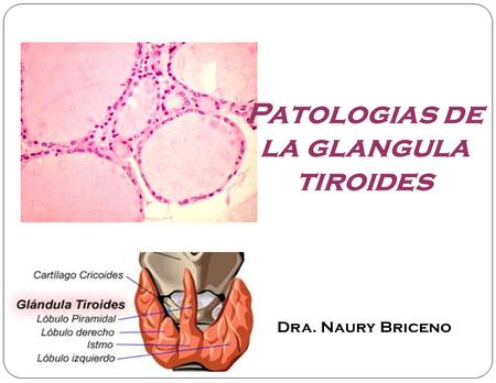 Patologias de la glangula tiroides