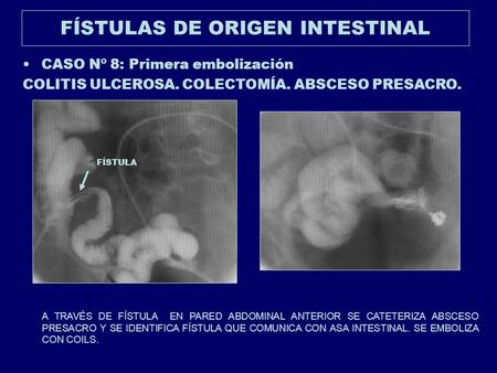 FÍSTULAS DE ORIGEN INTESTINAL