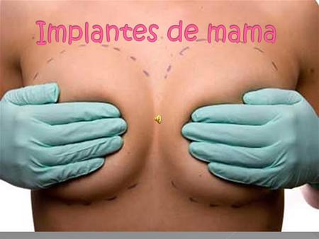 Los implantes pueden situarse en la mama a varios niveles. Subglandular: bajo la glándula mamaria y sobre la aponeurosis del músculo pectoral mayor.