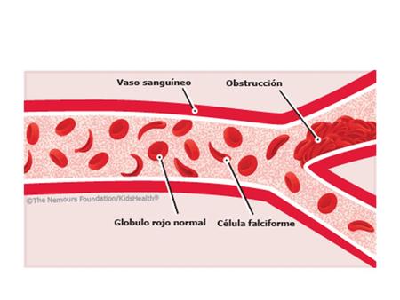 Clínica: -anemia crónica con episodios de crisis hemolíticas y vaso-oclusivos desencadenados por infecciones, deshidratación, desoxigenación y frío.