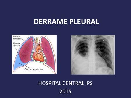 DERRAME PLEURAL HOSPITAL CENTRAL IPS 2015.