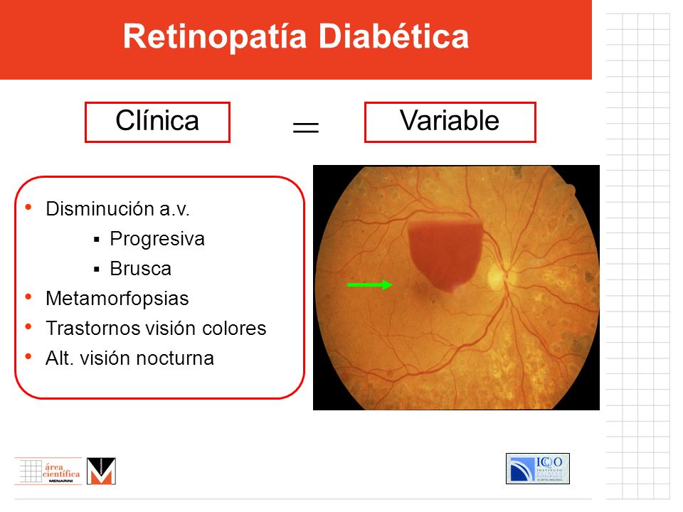 retinopatia diabetica clinica)