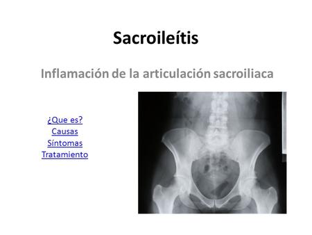 Inflamación de la articulación sacroiliaca