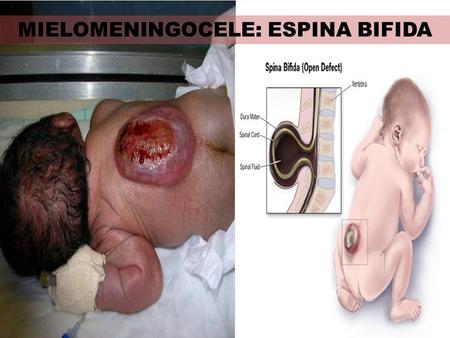 MIELOMENINGOCELE: ESPINA BIFIDA