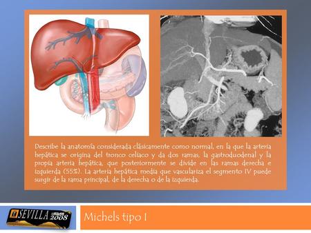 Michels tipo I Describe la anatomía considerada clásicamente como normal, en la que la arteria hepática se origina del tronco celiaco y da dos ramas, la.