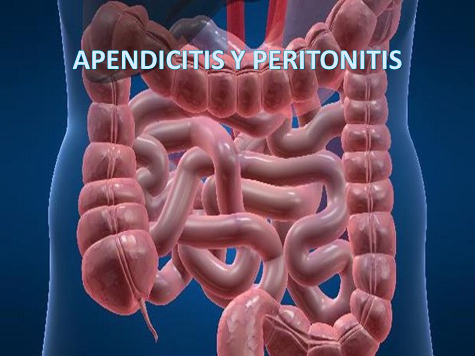 APENDICITIS Y PERITONITIS - ppt video online descargar
