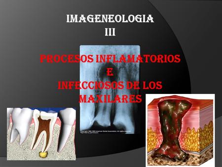 PROCESOS INFLAMATORIOS INFECCIOSOS DE LOS MAXILARES