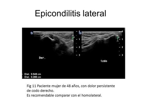 Epicondilitis lateral