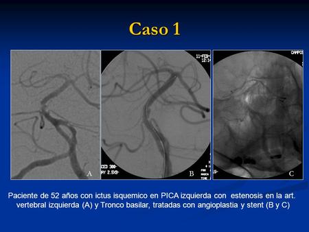 Caso 1 Paciente de 52 años con ictus isquemico en PICA izquierda con estenosis en la art. vertebral izquierda (A) y Tronco basilar, tratadas con angioplastia.