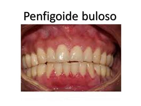 Penfigoide buloso.