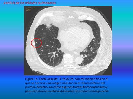 Figura 1a. Corte axial de TC torácico con colimación fina en el que se aprecia una imagen nodular en el lóbulo inferior del pulmón derecho, así como algunos.