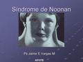 Síndrome de Noonan Ps Jaime E Vargas M A515TE.