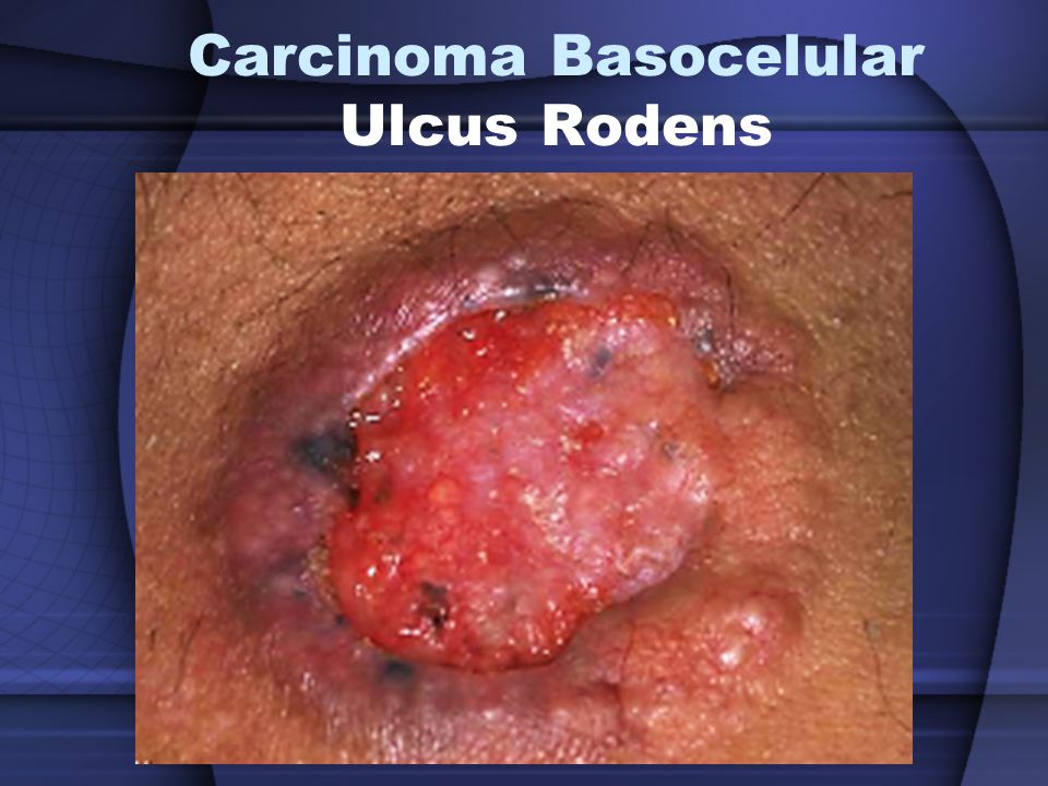 Resultado de imagen para ulcus rodens