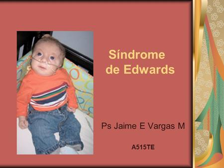Síndrome de Edwards Ps Jaime E Vargas M A515TE.