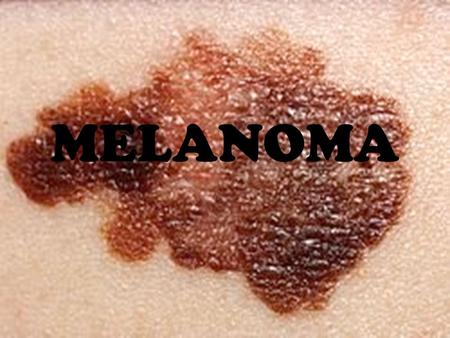 MELANOMA. HISTORIA ¿QUÉ ES? SÍNTOMAS CAUSAS DIAGNÓSTICO TRATAMIENTO ¿CÓMO SE PRODUCE? TIPOS DE MELANOMA VOCABULARIO BIBLIOGRAFÍA.