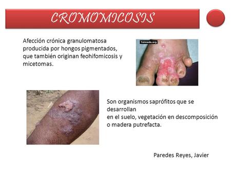 Afección crónica granulomatosa producida por hongos pigmentados, que también originan feohifomicosis y micetomas. Son organismos saprófitos que se desarrollan.