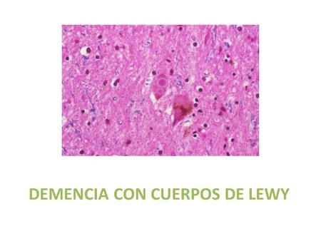 DEMENCIA CON CUERPOS DE LEWY. Cuerpos de Lewy  Inclusiones intraneuronales constituidas por proteinas que contiene proteina presinaptica (a - sinucleina)