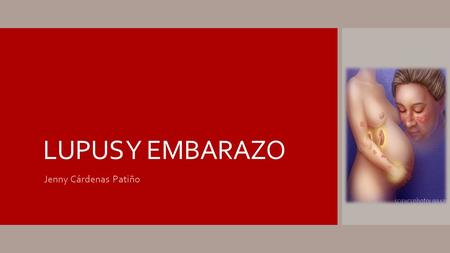 LUPUS Y EMBARAZO Jenny Cárdenas Patiño. LES  El LES es una enfermedad autoinmune multisistémica de causa desconocida, caracterizada por la producción.