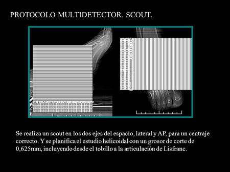 PROTOCOLO MULTIDETECTOR. SCOUT. Se realiza un scout en los dos ejes del espacio, lateral y AP, para un centraje correcto. Y se planifica el estudio helicoidal.