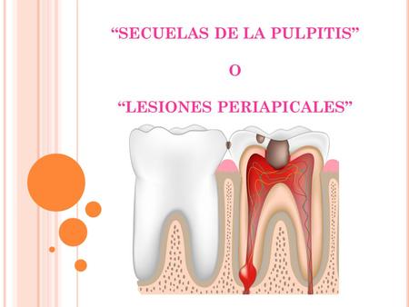 “SECUELAS DE LA PULPITIS” O “LESIONES PERIAPICALES”