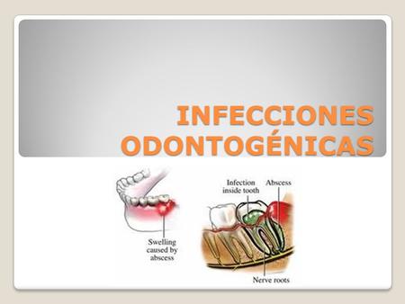 INFECCIONES ODONTOGÉNICAS