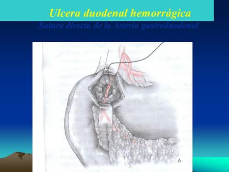 Ulcera duodenal hemorrágica