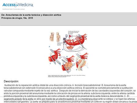 Fecha de descarga: 01/07/2016 Copyright © 2016 McGraw-Hill Education. All rights reserved. Ilustración de la reparación aórtica distal de una disección.
