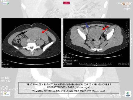 SE VISUALIZA ESTUCTURA HETEROGENEA EN VACIO,FII Y PELVIS QUE ES COMPATIBLE CON BAZO.( fechas rojas) TAMBIEN SE VISUALIZA LIQUIDO LIBRE EN PELVIS (flecha.