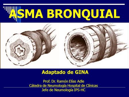 ASMA BRONQUIAL Adaptado de GINA Prof. Dr. Ramón Elías Adle