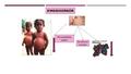 Permeabilidad capilar