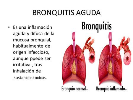 BRONQUITIS AGUDA Es una inflamación aguda y difusa de la mucosa bronquial, habitualmente de origen infeccioso, aunque puede ser irritativa, tras inhalación.
