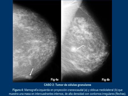 CASO 2: Tumor de células granulares Figura 4: Mamografía izquierda en proyección craneocaudal (a) y oblicua mediolateral (b) que muestra una masa en intercuadrantes.