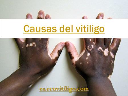 Causas del vitiligo. Las causas del vitiligo Las causas del vitiligo son aún objeto de investigacionesvitiligo El efecto final se debe a la desaparición.
